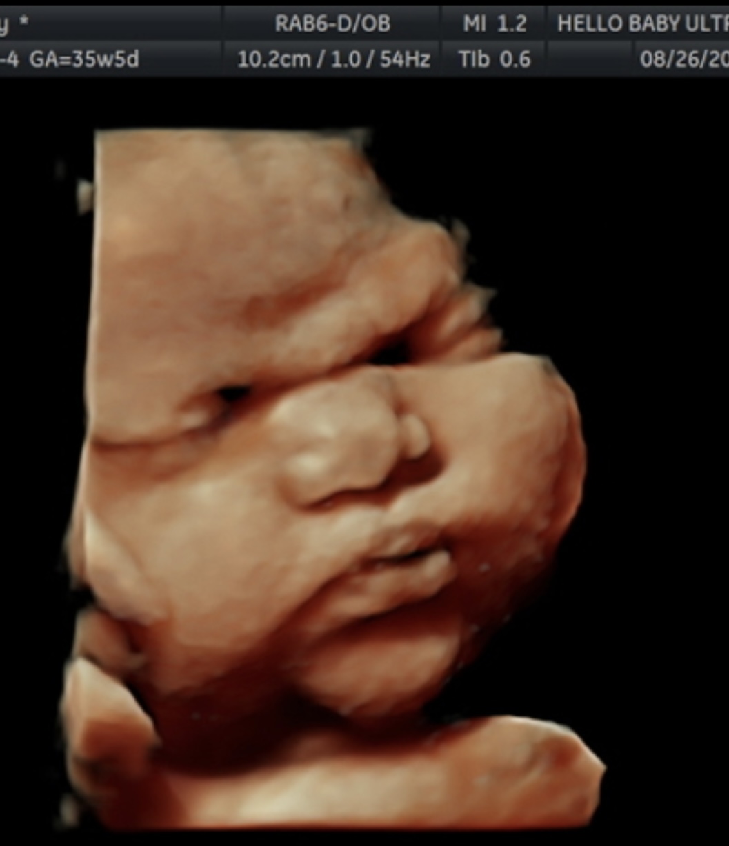 HD ultrasound photo